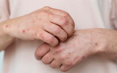 Caso de sarampo é confirmado no Rio e autoridades reforçam importância da vacinação